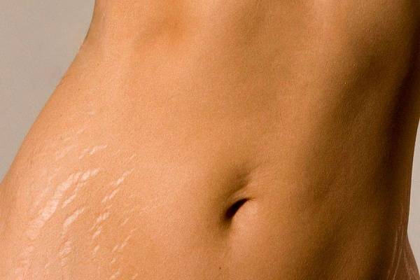 Процедуры от растяжек восстановят гладкость кожи